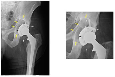 Inflammation and Bone Repair: From Particle Disease to Tissue Regeneration